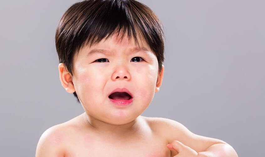 Dấu hiệu dị ứng đạm sữa bò ở trẻ trên 1 tuổi, bao gồm phát ban và khó thở