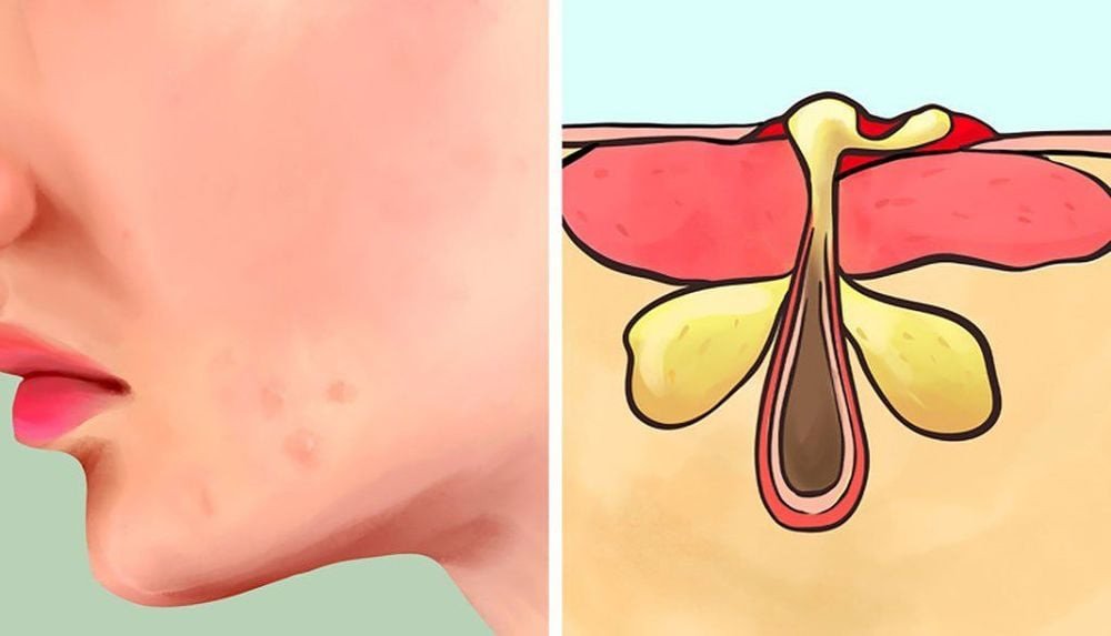 Kem dưỡng ẩm Aveeno có thể ảnh hưởng đến da mụn