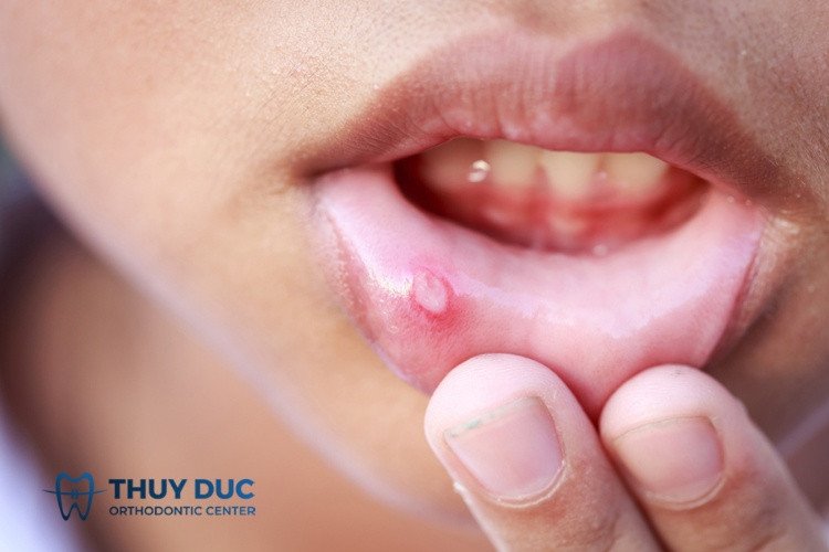 Loét do nhiệt miệng có ranh giới rõ ràng