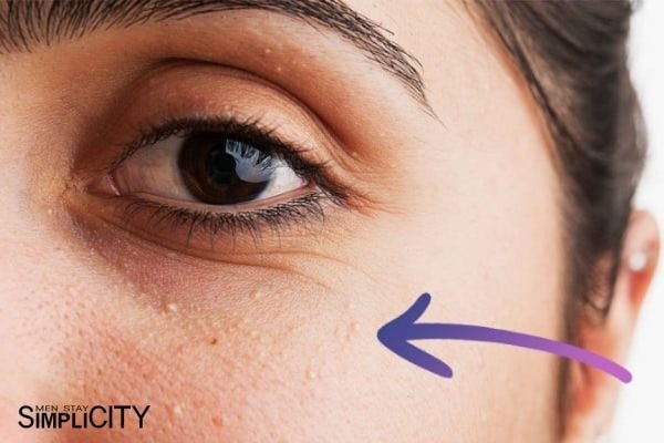 Lưu ý cần biết khi sử dụng kem trị mụn thịt