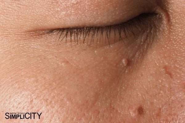 Lý do nam giới nên sử dụng kem trị mụn thịt