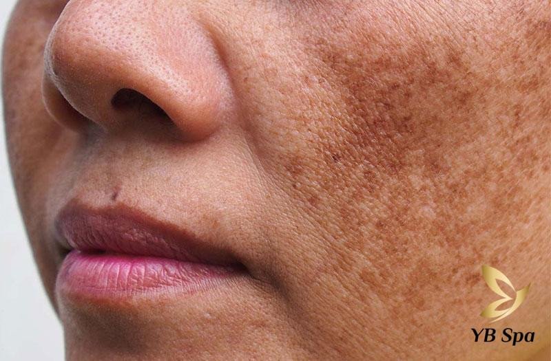 Minh họa tình trạng da khô sạm, nám cần cải thiện bằng skin booster