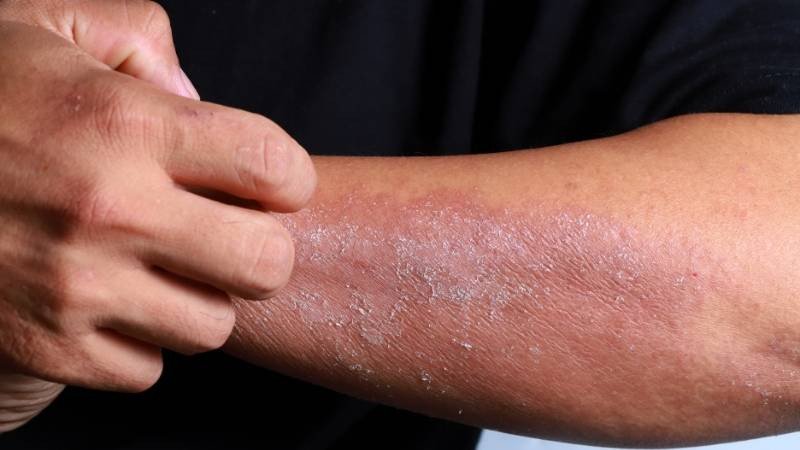Những tác dụng phụ thường gặp khi sử dụng lanolin cream