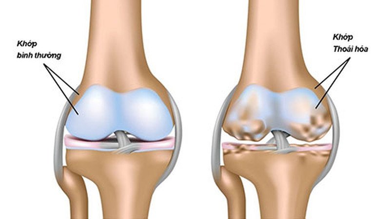 Sụn vi cá mập và glucosamine đều hỗ trợ phục hồi xương khớp